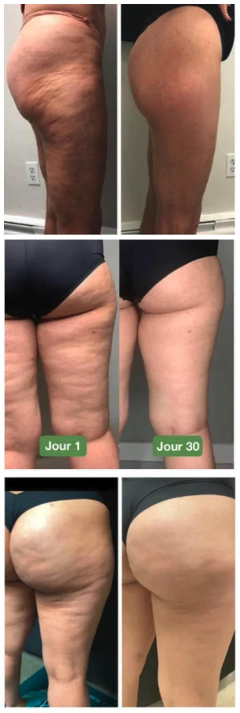 Trois avant-après de cuisses : l'aspect capitonné de la peau est visiblement lissé après un mois de port quotidien