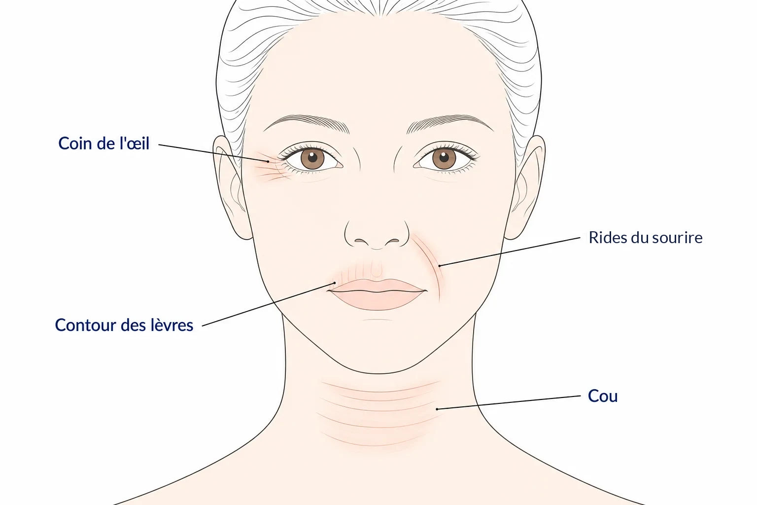 Schéma d'un visage de face où quatre zones sont marquées : le coin de l'œil, les rides du sourire, le contour des lèvres et le cou