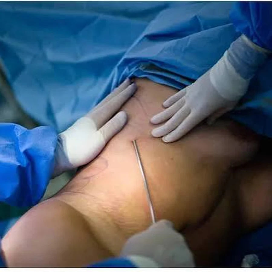 Intervention de liposuccion du tissu lipœdémateux au bloc opératoire